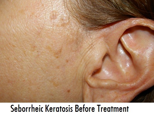 Keratosis Treatment - How To Remove Keratosis @ Home