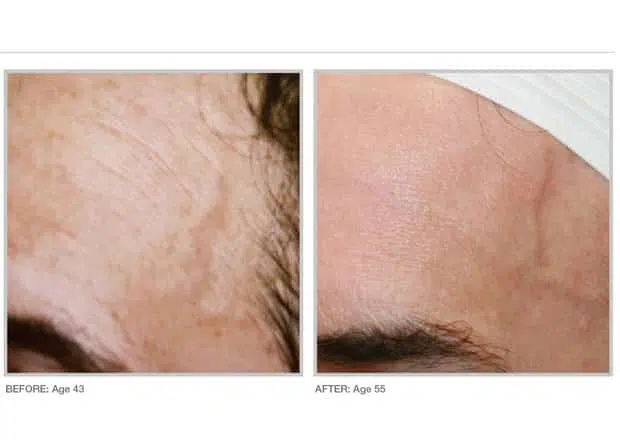 BBL forehead before and after
