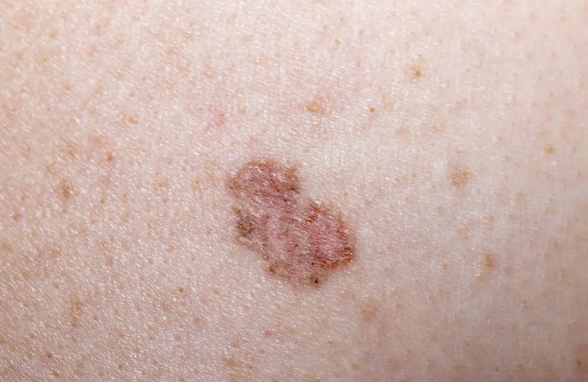 Irregular mole