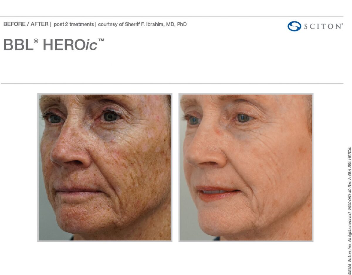 Sciton Before and After