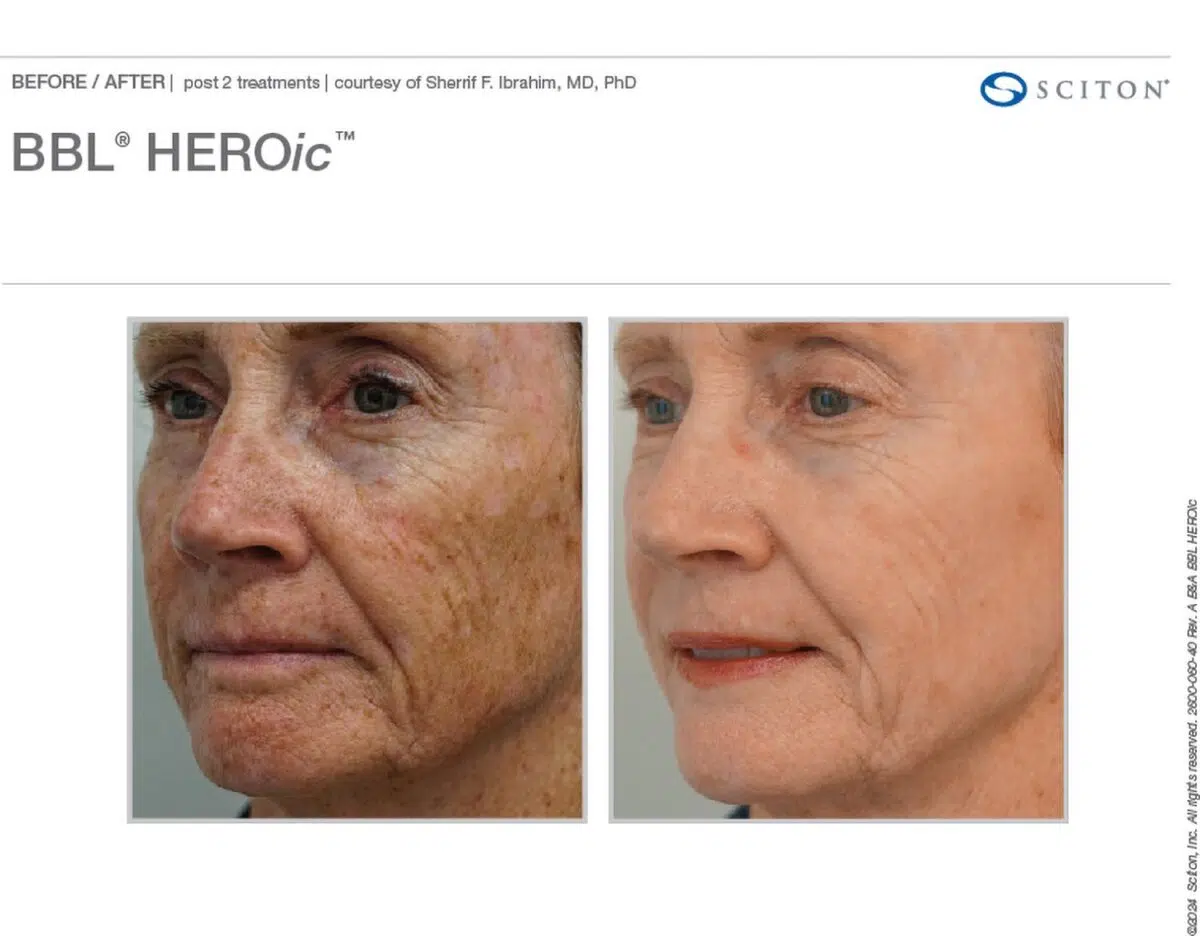 Sciton Before and After