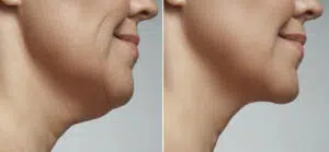 Get rid of double chin with kybella