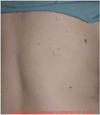 skin spots - on back showing Seborrheic Keratoses