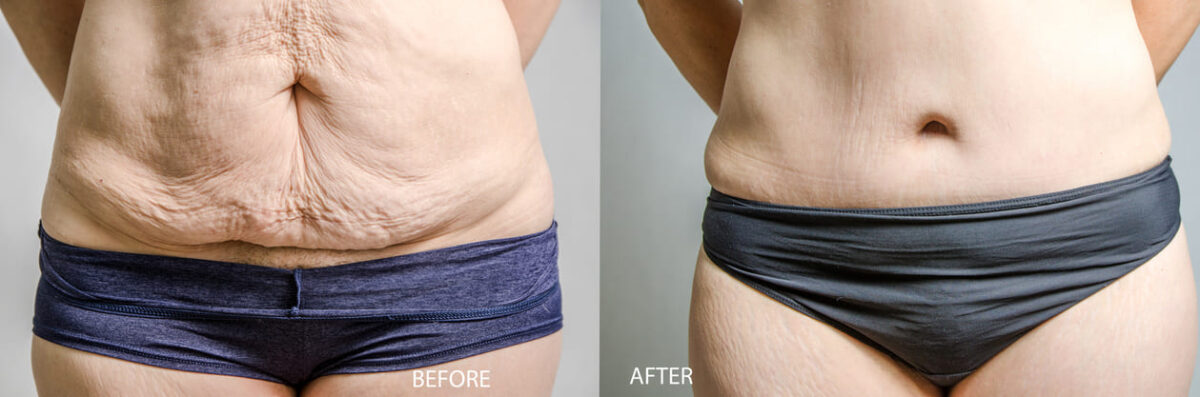 Abdominoplasty aka Tummy Tuck