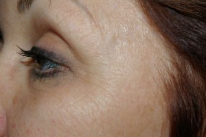 Before Eye Wrinkles Treatment