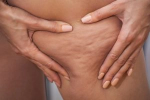4 Step Workout to lose cellulite