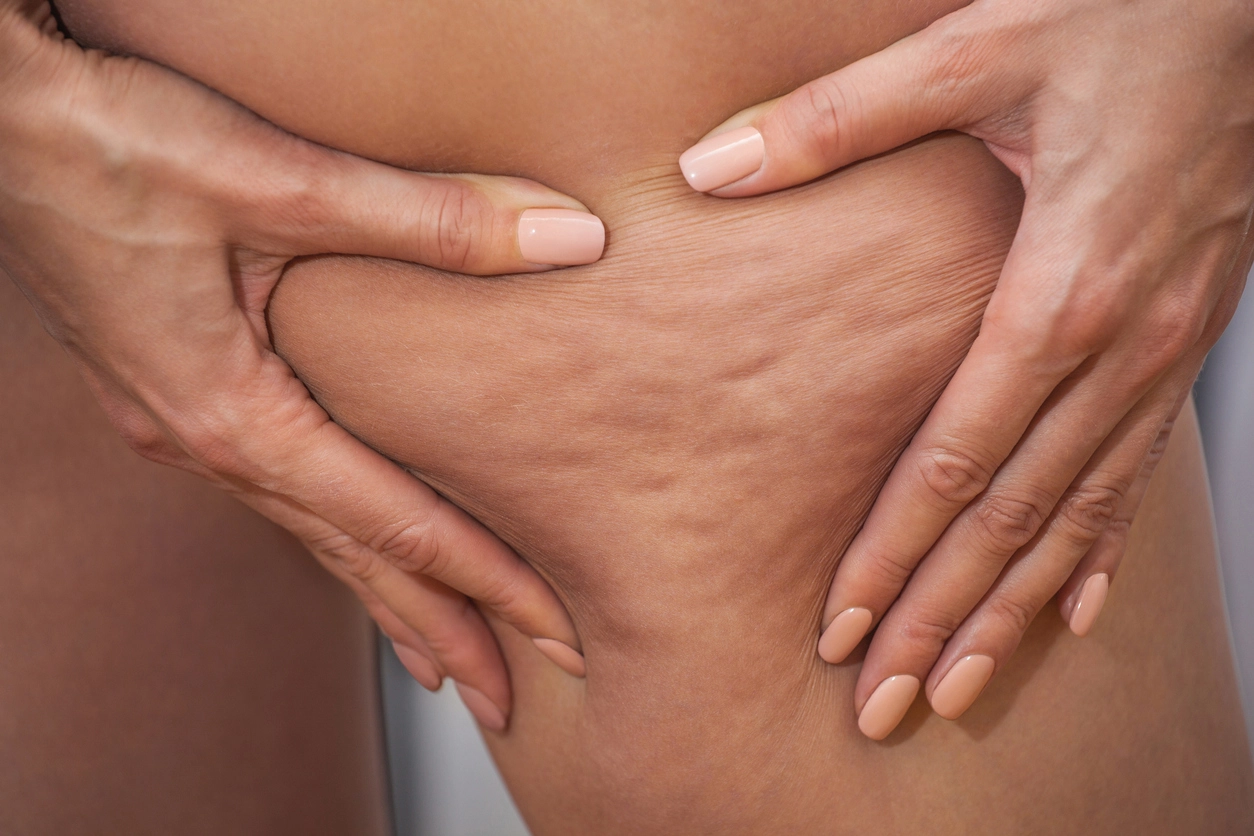 4 Step Workout to lose cellulite