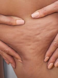 cropped-cellulite.jpg