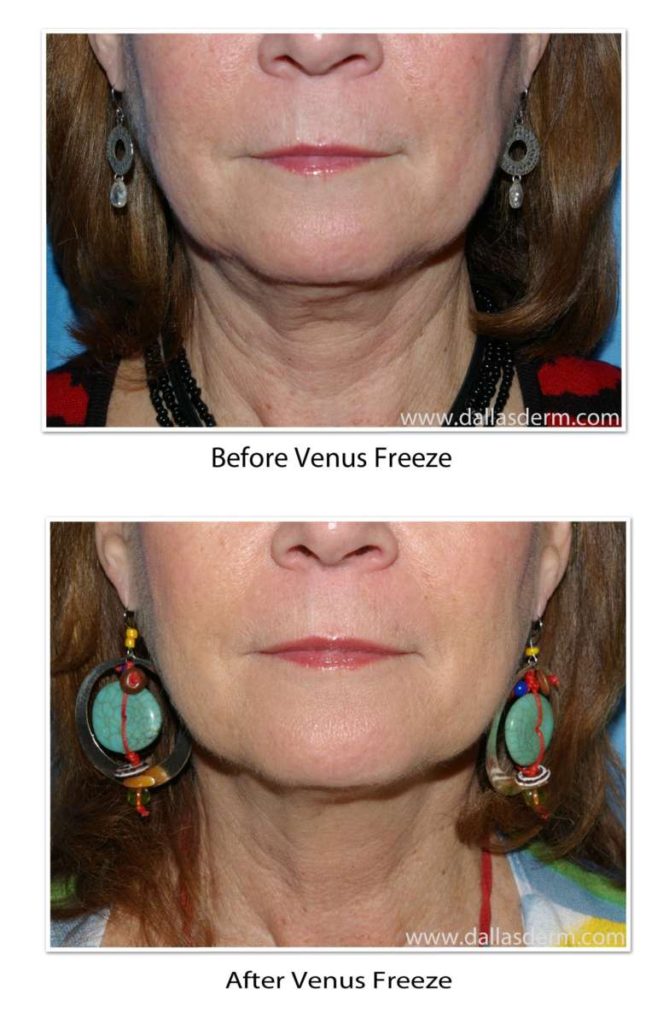 Venus Freeze before and after pictures