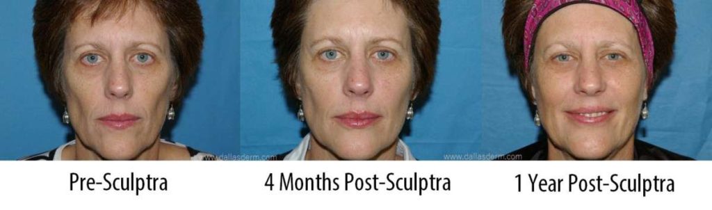 Sculptra Patient