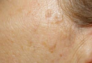 Remove Seborrheic Keratoses