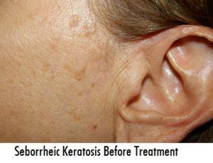 Seborrheic Keratosis Before Treatment - Removing Seborrheic Keratosis