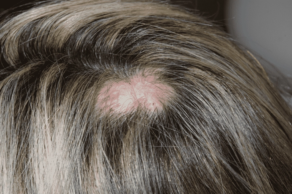 Losing my hair_alopecia