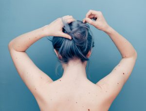 gray haired woman with moles on her back