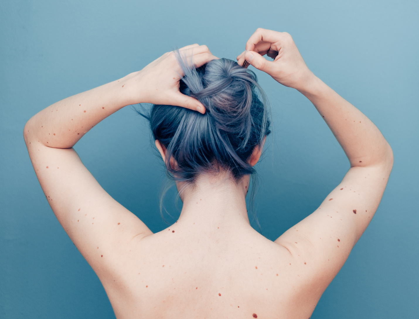 gray haired woman with moles on her back