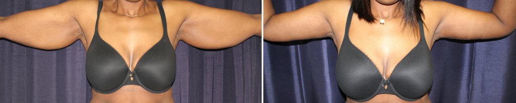 Brachioplasty