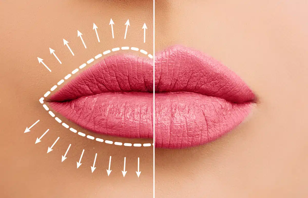 before and after lip fillers