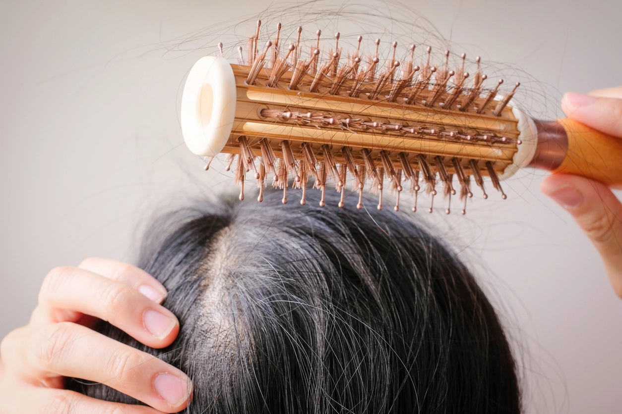 Hair Loss in Women