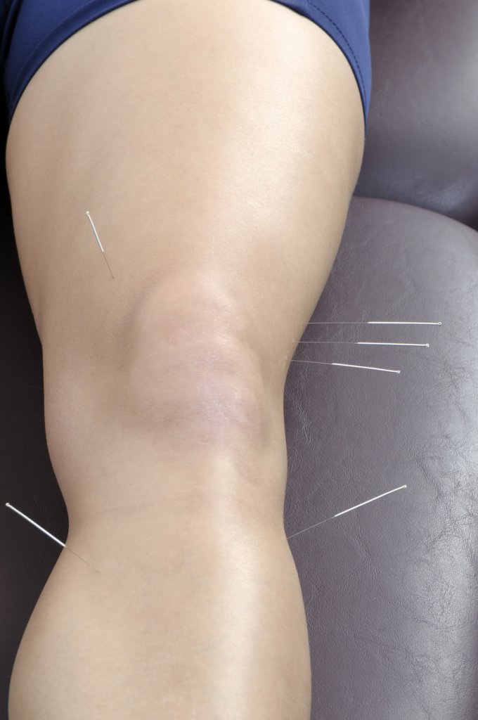 Acupuncture