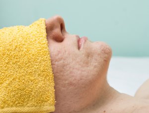 Laser Treatments for Acne Scars