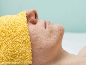 Laser Treatments for Acne Scars