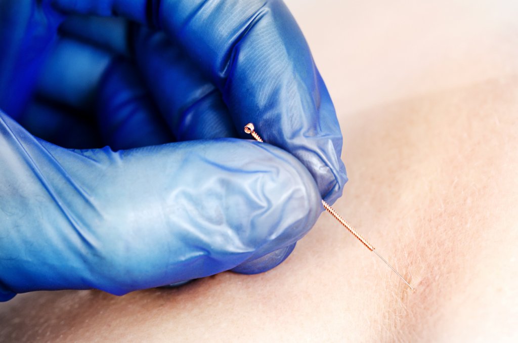 Physiotherapist Doing a Dry Needling