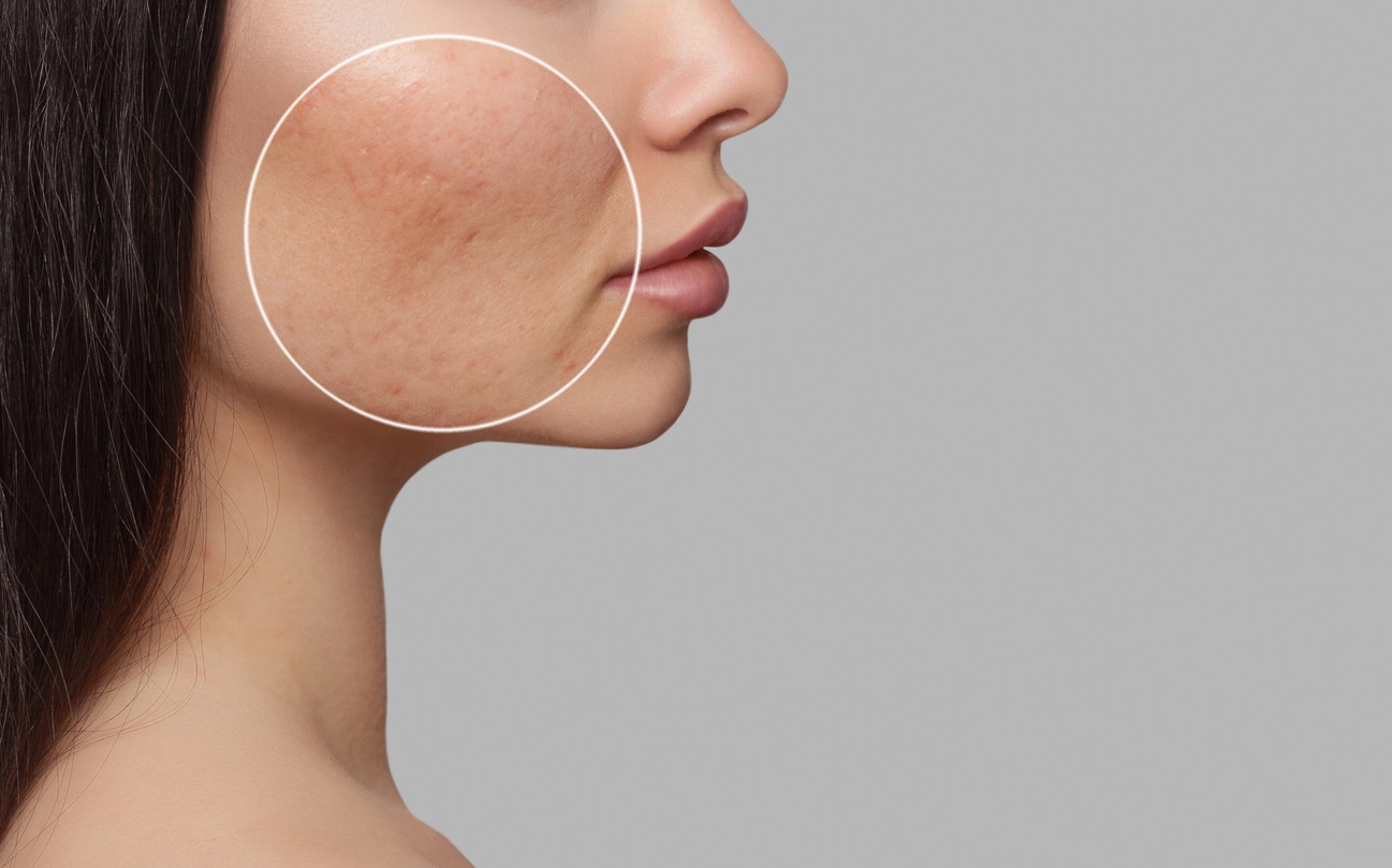 Laser treatment for acne scarring