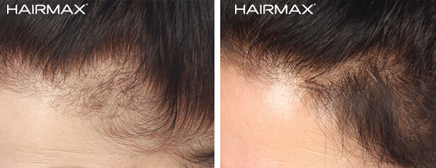 hairmax_before_after_female2