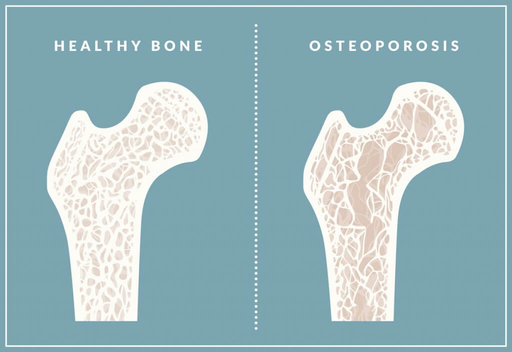 Osteoporosis