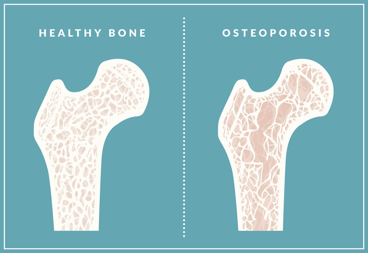 Fight Osteoporosis by lifting weights