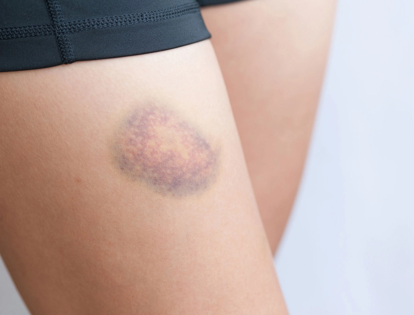 bruising easily as you get older