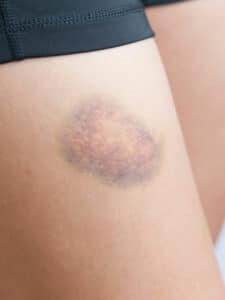 cropped-Bruise-1.jpg