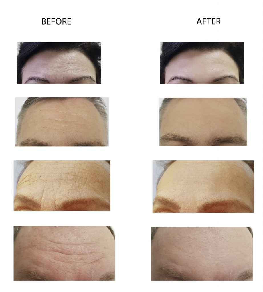 Botox Injections before and after 