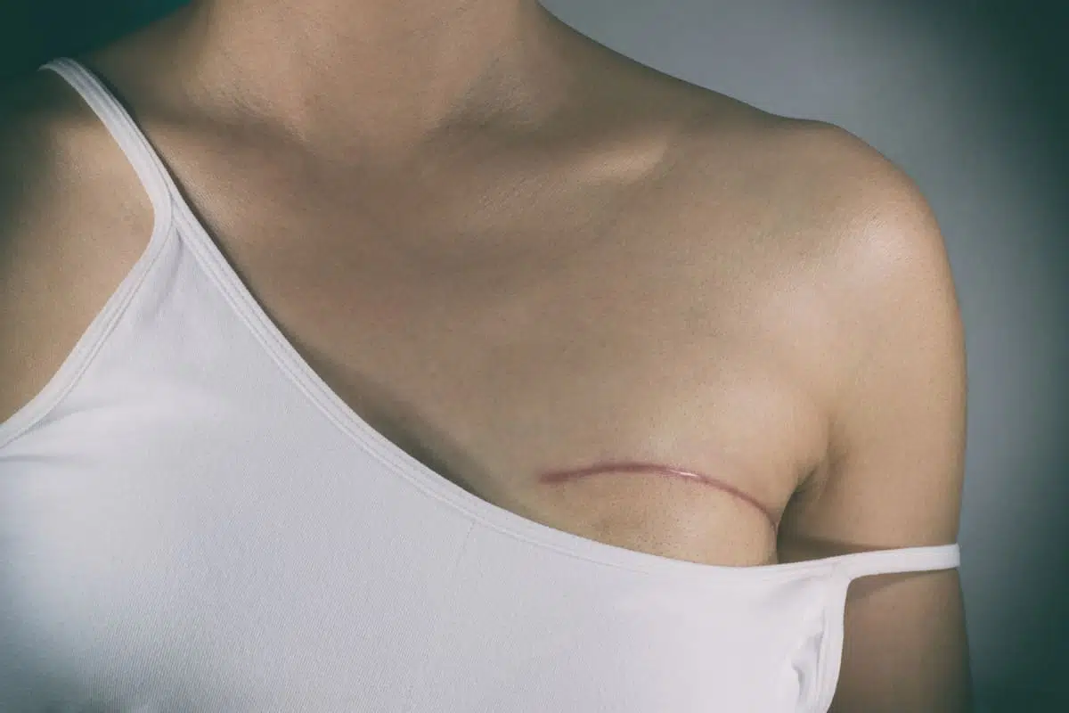 Breast cancer surgery