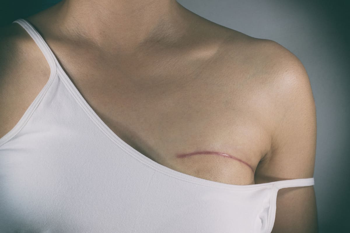 Breast cancer surgery