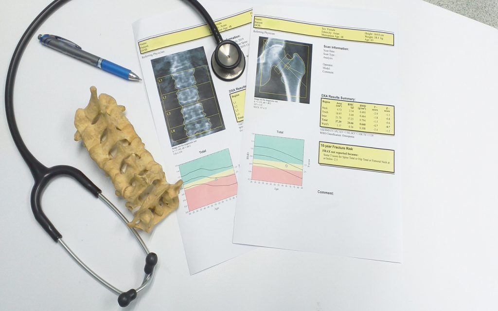 Knowing your bone density is the first step in reversing osteporosis