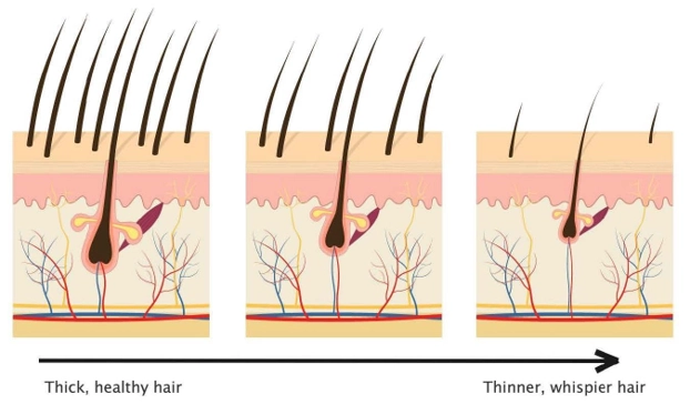 thinning hair in women