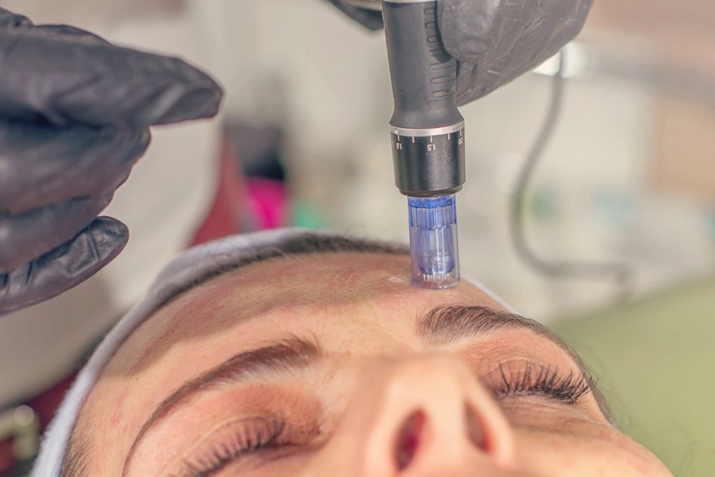microneedling