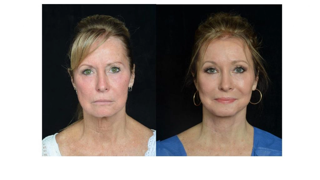 facelift before and after