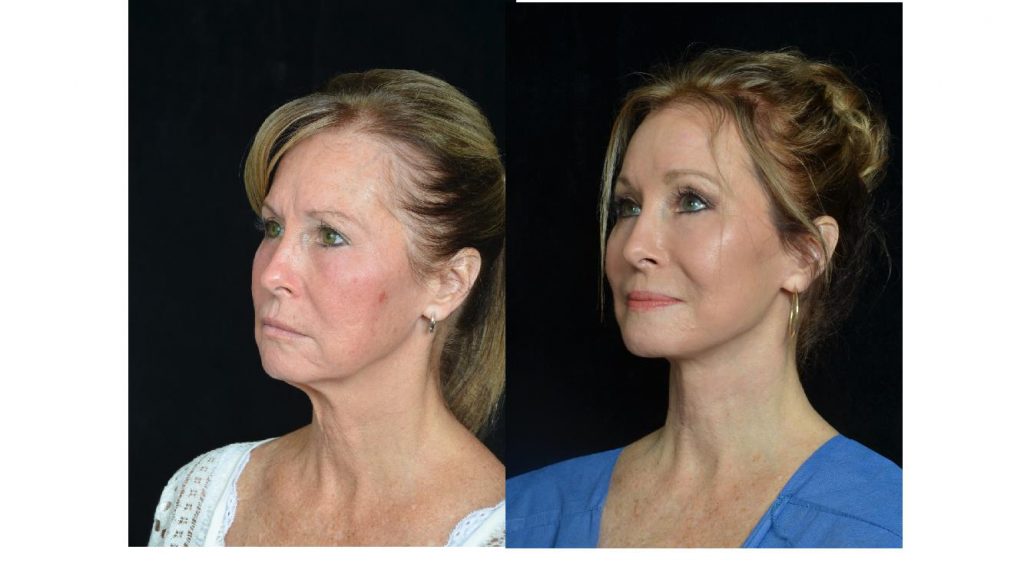 facelift surgery