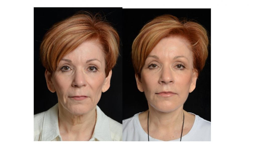 new facelift surgery