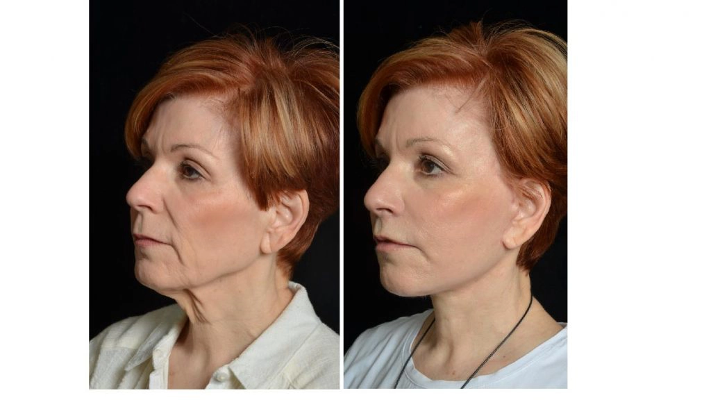 facelift before and after