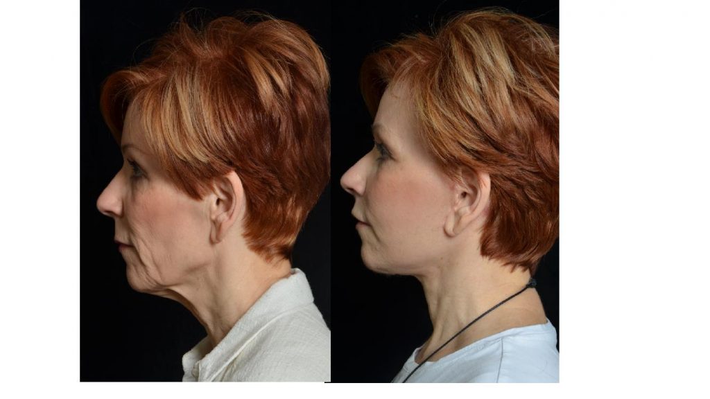 facelift before and after