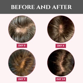 Let's Talk About Female Pattern Hair Loss | PRIMEWomen.com