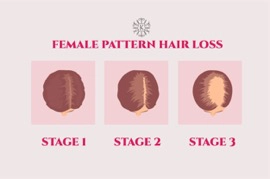 Let's Talk About Female Pattern Hair Loss | PRIMEWomen.com
