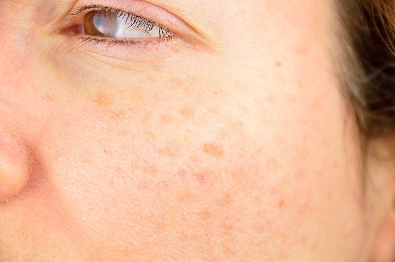 age spots