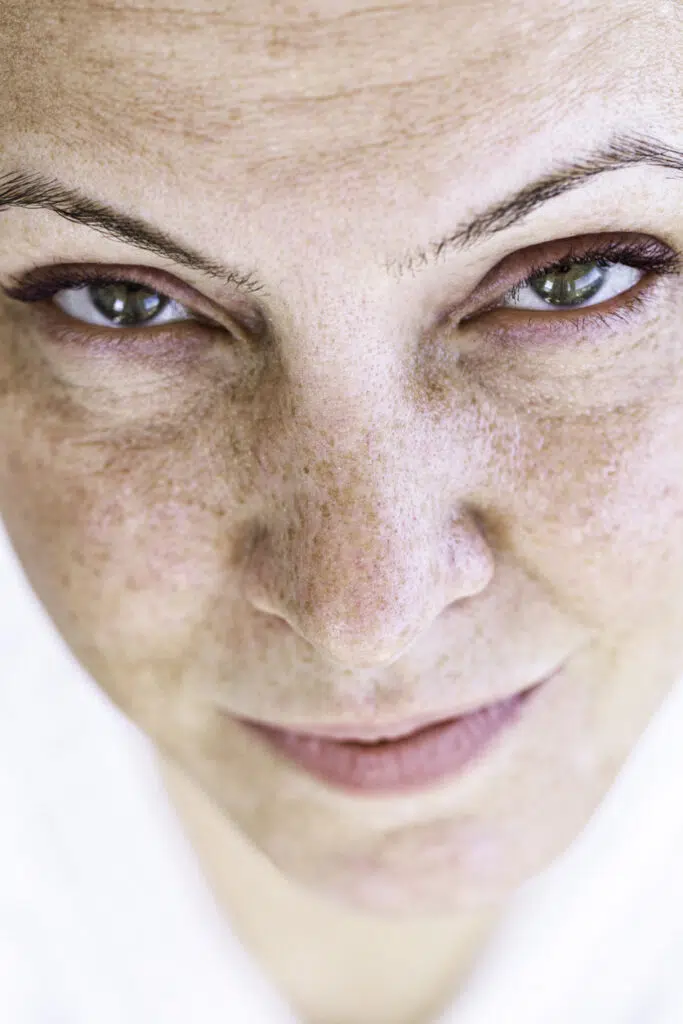 Hyperpigmentation