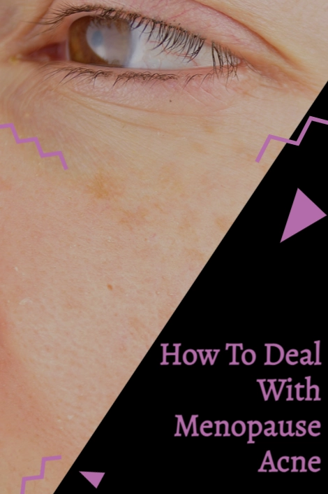 How to deal with menopause acne
