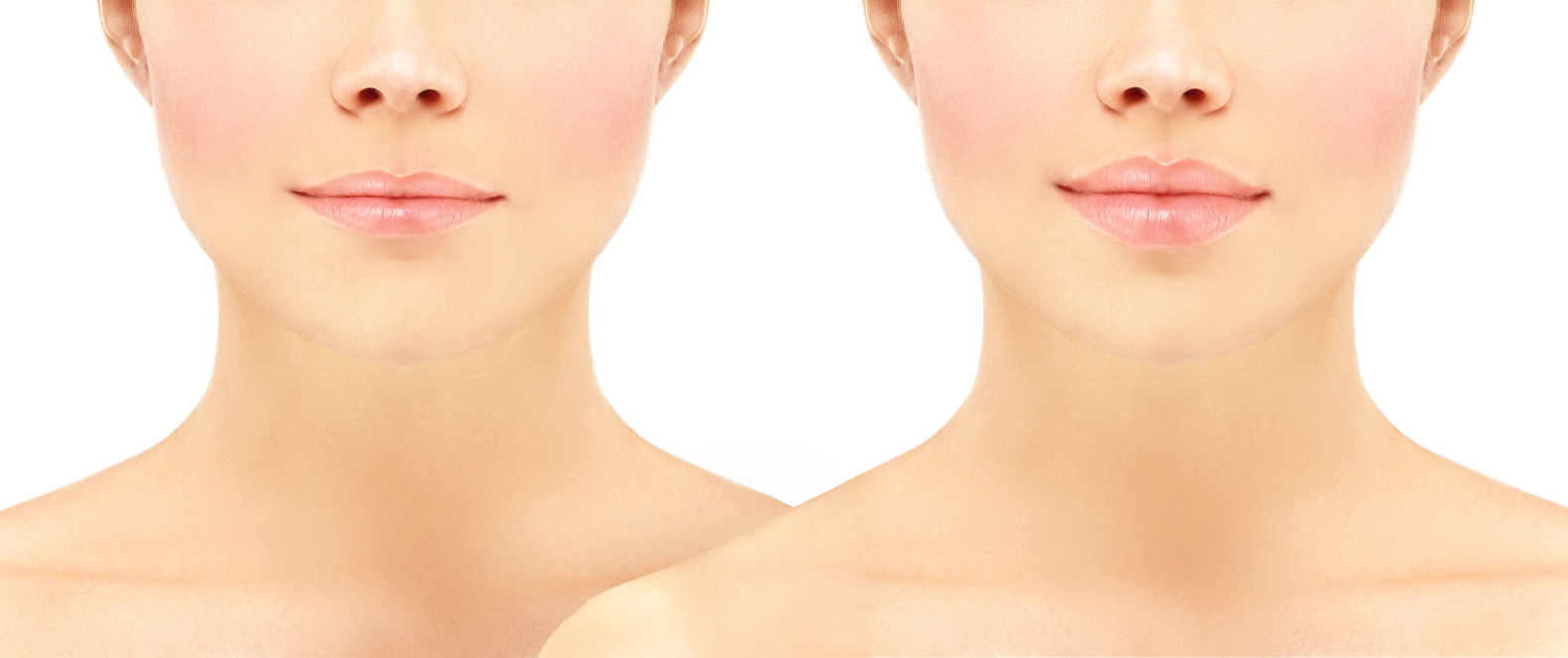 Everything you need to know about getting a lip flip
