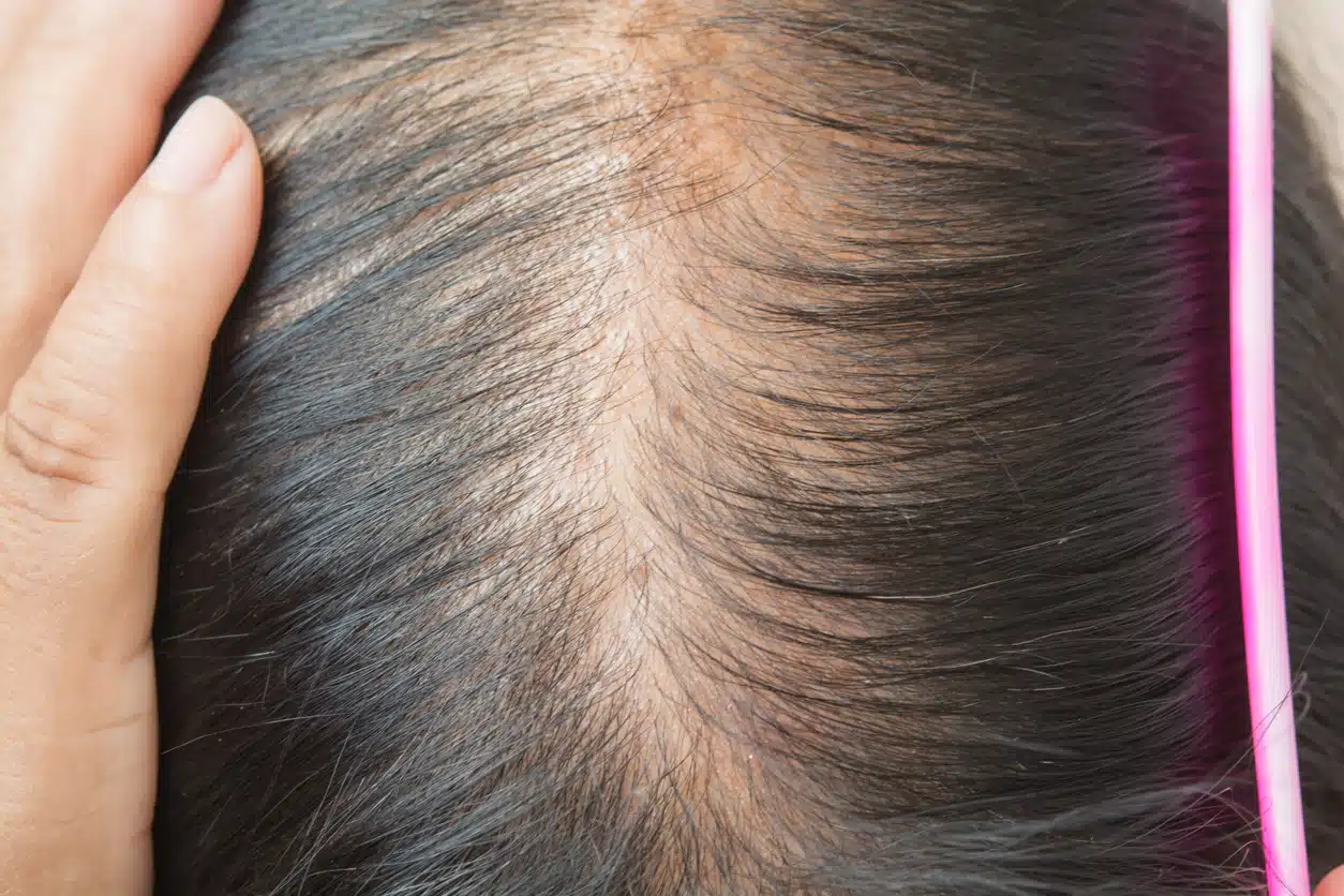 Widening hair part; hair loss; thinning hair